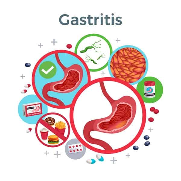Gastritis-min